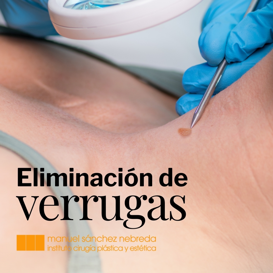 SanchezNebreda's tweet photo. 🟤Adiós a las #verrugas del cuello y axilas! Estas antiestéticas infecciones virales son muy comunes, pero que pueden extirparse definitivamente.
Olvídate de remedios caseros ineficaces y tratamientos dolorosos y pide tu cita con el Dr. #sancheznebreda 

https://t.co/xEYCgPQxUa https://t.co/92qnUjV9su