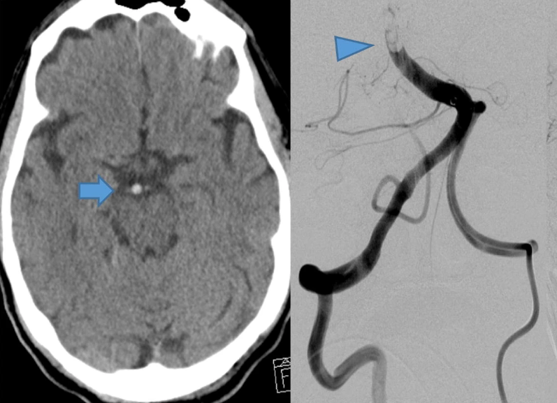 #6: Consider CT scans on before ICU 
For the decreased LOC patient, consider whether the patient needs a CT head (or CTA) emergently. 

If decreased LOC is unexplained or sudden, once intubated, go straight to CT/CTA. If this is an acute stroke or bleed, minutes matter.