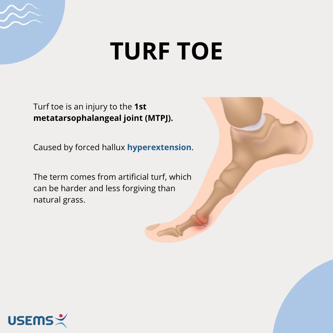 UndergradSEMS's tweet photo. Common #MSK conditions!
Episode 8: Turf toe
#turftoe #football https://t.co/haAVkdwrO0