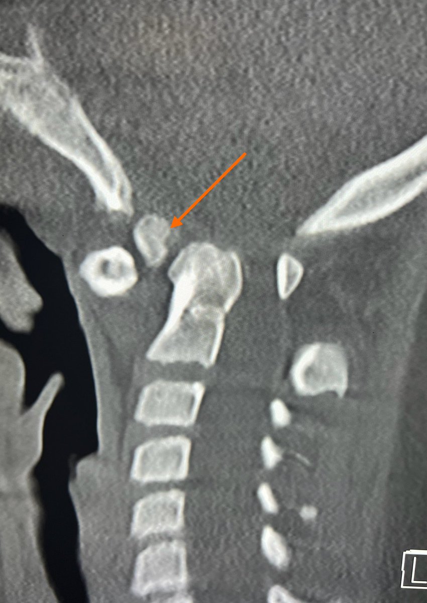 drmankad's tweet image. Tip of the day 💡: Atlantoaxial dislocation due to os odontoideum (arrow) is a well known association in patients with Down's syndrome.