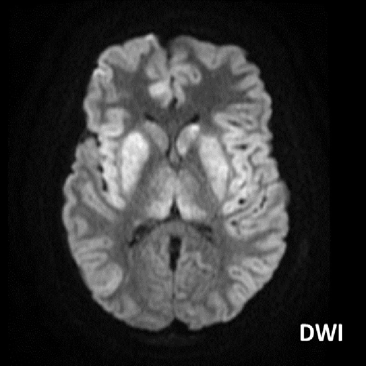 #AJNRcc >> June 3, 2024 >> What is the diagnosis for this 18-year-old woman with cirrhosis presents with impaired consciousness? Submit your answer at ow.ly/vhyN50S7r57.