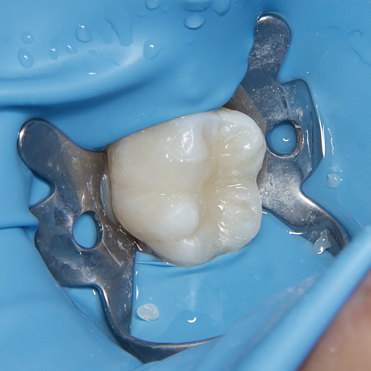 Only a beautiful restoration✨

حشوة تجميلية مع ازالة التسوس 🤍