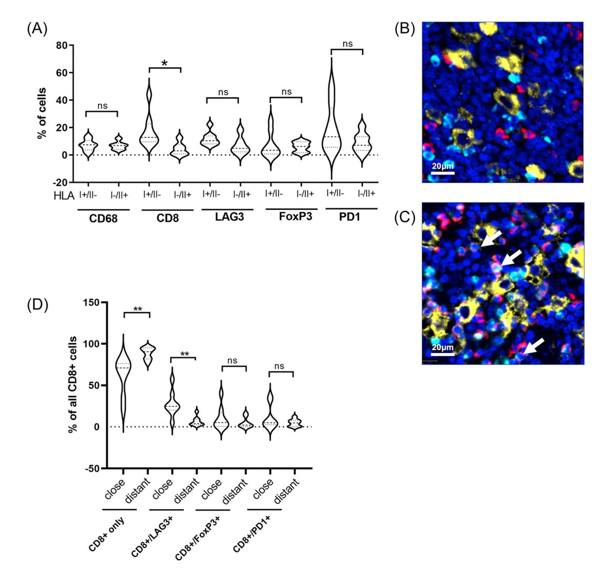 Important study, exploring how HLA-I expression of HRS cells shapes the HL TME led by Wolfram Klapper and <a href="/UKSH_KI_HL/">Universitätsklinikum Schleswig-Holstein</a> team now <a href="/Hemasphere_EHA/">HemaSphere Journal (IF = 14.6)</a>: Higher CD8+ T-cell content w higher LAG3 expression if close to HRS cells as a potentially targetable feature. t.ly/5s6yt