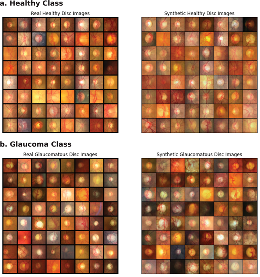 ARVOtvst's tweet photo. Abadh Chaurasia et al. @ResearchMenzies assess the efficacy of synthetic optic disc images for detecting glaucomatous optic neuropathy using deep learning, https://t.co/naPG2F4oYC. https://t.co/eJkDelT0u8