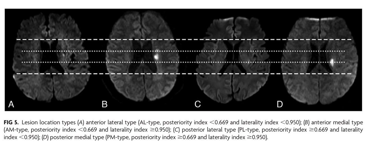 'Lesion Indexes Predict Early Neurologic Deterioration in Lenticulostriate Single Small Subcortical Infarction' doi.org/10.3174/ajnr.A… #Stroke