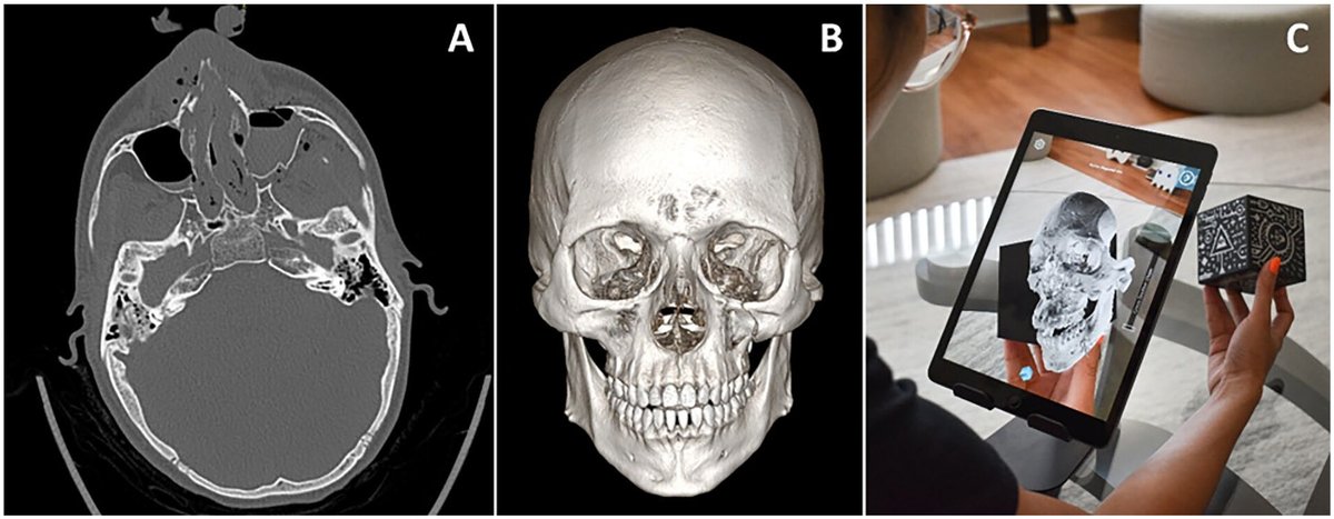 Jesse Courtier, MD (@jessecourtier) on Twitter photo ""Less experienced clinicians found the #augmentedreality model required less effort, was less frustrating, and was preferred for #fracture displacement characterization" <a href="/UCSFPlastic/">UCSF Plastic Surgery</a> and <a href="/UCSFimaging/">UCSF Imaging</a> journals.sagepub.com/doi/epub/10.11… ""Less experienced clinicians found the #augmentedreality model required less effort, was less frustrating, and was preferred for #fracture displacement characterization" <a href="/UCSFPlastic/">UCSF Plastic Surgery</a> and <a href="/UCSFimaging/">UCSF Imaging</a> journals.sagepub.com/doi/epub/10.11…