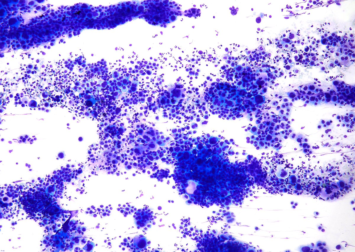 MOST photogenic example of a rare tumor - “Primary Pancreatic Anaplastic Carcinoma”, one of the deadliest human malignancies. (Pancreas, EUS-FNA)