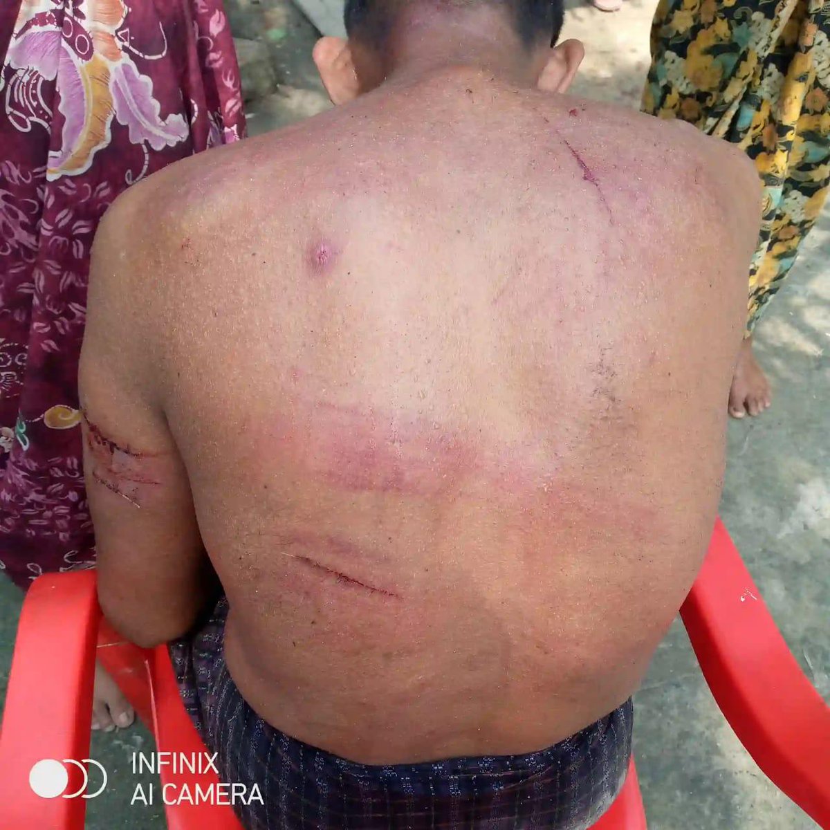 OmarfaukR's tweet photo. #BreakingNews‌ Maungdaw 

On June/03/2024

A 41-year- old mental #Rohingya while he was going to Lobboiza para from Bokshu para, village to bring rice with permission of AA, he was beaten brutally &amp; left in dire condition by AA terrorists. Their inhumanity can be seen in pics https://t.co/0ePFdrJthO