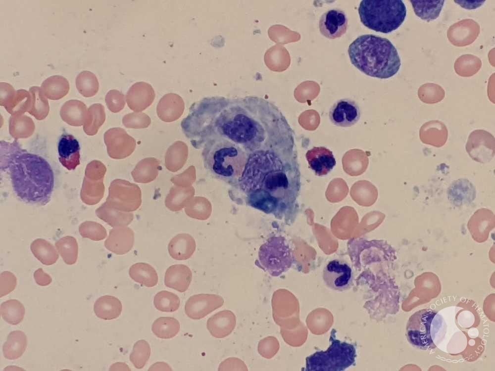 Hemophagocytic lymphohistiocytosis | ASH Image Bank | American Society of Hematology imagebank.hematology.org/image/64118/he… #ASHImageBank
