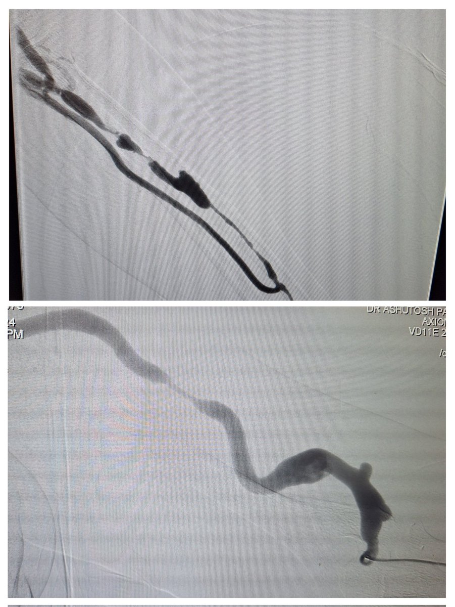 vascularsrgn's tweet photo. Importance of training patients when you work in peripheries , both these patients were getting dialysis at remote centres and they felt there is change in thrill nature and reported for intervention ..back.on HD now
@VarenyamVasc should be happy #accessEd #KidneyDisease https://t.co/gmCuTKZ7Gc