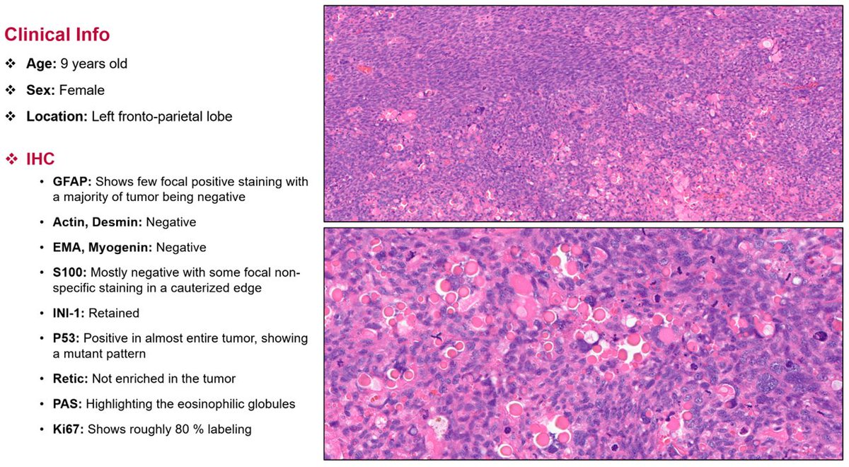 Methylation Case of the Week:

9 year old female patient with a left fronto-parietal mass. Negative for glial markers. Fits for a primary CNS sarcoma. Note the eosinophilic globules. Want to roll the DICE for a diagnosis? #pathology #neuropath #Pathtwitter