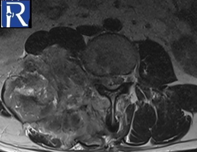 radiologybmj's tweet photo. A 28-year-old male patient with multiple osteochondromas was admitted with an enlarging soft tissue mass in the right paravertebral area.#radiology #mskrad #radres #radtwitter #radstudent #orthopedic #orthotwitter #medstudenttwitter #medtwitter #futureradres #radstudent https://t.co/eZnUWdfyEo