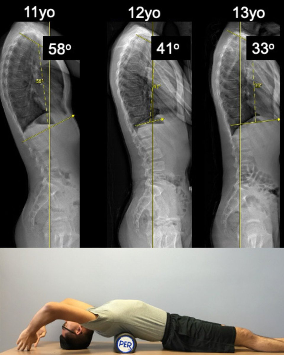 One of our members, Dr. David Skaggs, MD, created this great visual on how 60 seconds of stretching over a bolster every day can correct kyphosis and maintain good posture. #SRS #ScoliosisExercises #ScoliosisAwarenessMonth <a href="/dr_skaggs/">Dr. David Skaggs</a>

Learn more here: srs.org/Patients/Condi…