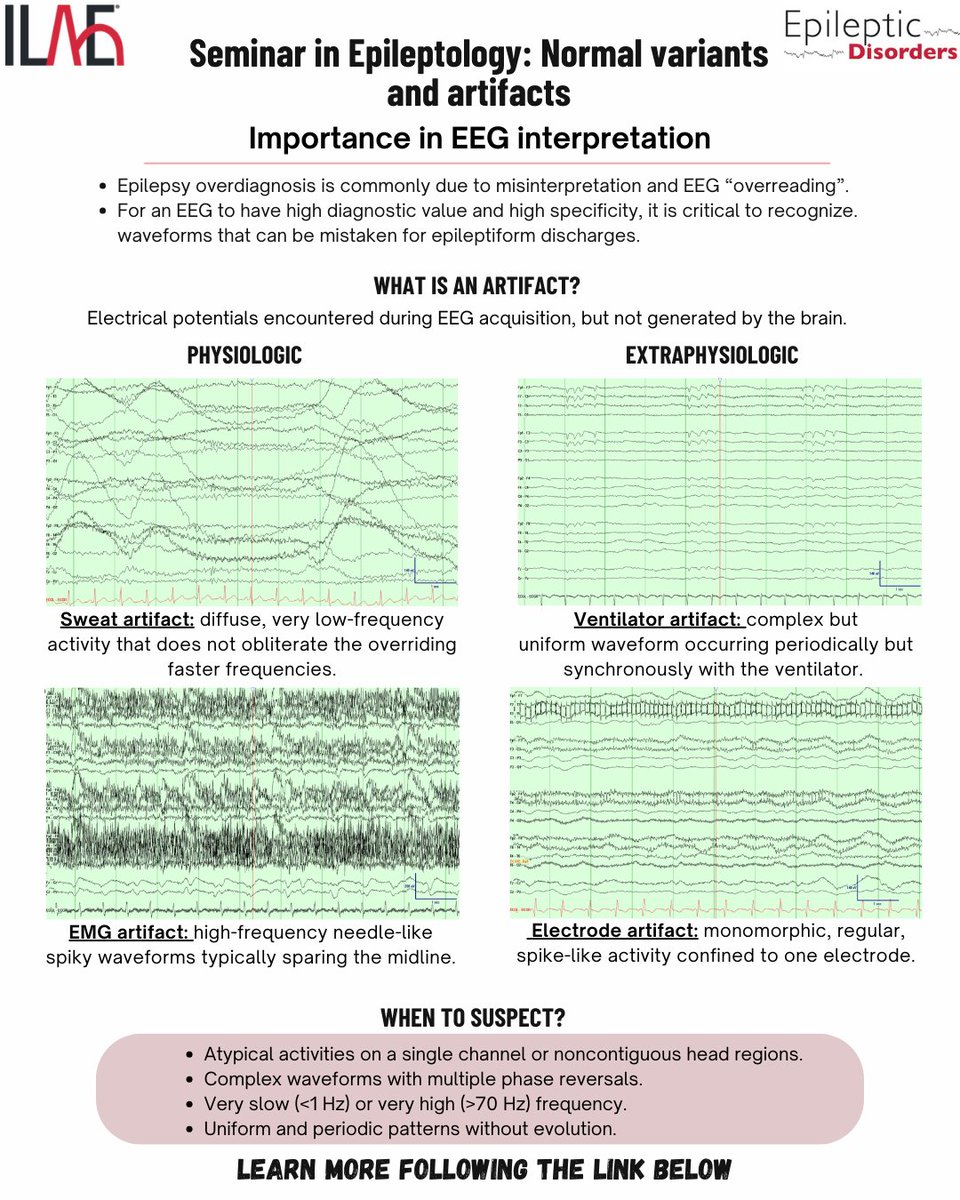 Epileptic Disorders (@epidisorders) on Twitter photo In this Seminar in Epileptology Amin et al. highlight the importance of recognizing different artifacts during EEG interpretation. onlinelibrary.wiley.com/doi/epdf/10.10… <a href="/mariajpol/">Maria José Polania Puentes</a> <a href="/RoohiKatyal/">Roohi Katyal</a> <a href="/fabnascimen/">Fábio Nascimento</a> <a href="/SBeniczky/">Sandor Beniczky</a> <a href="/WileyNeuro/">Wiley Neuro</a> <a href="/WileyHealth/">Wiley Clinical Health</a> @Ilaeweb In this Seminar in Epileptology Amin et al. highlight the importance of recognizing different artifacts during EEG interpretation. onlinelibrary.wiley.com/doi/epdf/10.10… <a href="/mariajpol/">Maria José Polania Puentes</a> <a href="/RoohiKatyal/">Roohi Katyal</a> <a href="/fabnascimen/">Fábio Nascimento</a> <a href="/SBeniczky/">Sandor Beniczky</a> <a href="/WileyNeuro/">Wiley Neuro</a> <a href="/WileyHealth/">Wiley Clinical Health</a> @Ilaeweb