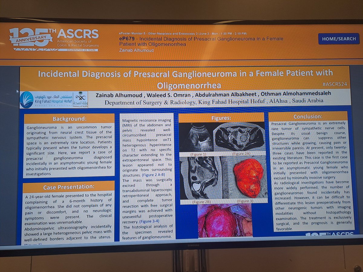 Zainab_Alhamoud's tweet photo. Today, I was honored to represent Ahsa health cluster &amp; King Fahad Hospital in Alhufouf at ASCRS 2024, presenting our poster about " Incidental Diagnosis of Presacral Ganglioneuroma managed by minimal invasive laparoscopic procedure #ASCRS24 https://t.co/dcMOE5XKx9