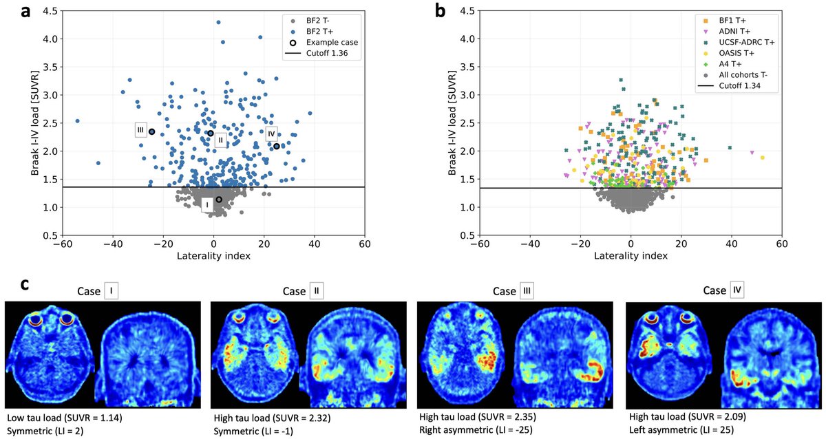 🚨 New <a href="/biofinder_study/">BioFINDER</a> preprint:

A machine learning-based prediction of tau load and distribution in Alzheimer's disease using plasma, MRI and clinical variables

The goal was to predict tau load (SUVR) and distribution (hemispheric asymmetry) using broadly accessible variables