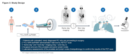 UroToday.com (@urotoday) on Twitter photo #CLARIFY: PET using 64Cu-SAR-bisPSMA in patients with high-risk #ProstateCancer prior to radical prostatectomy. Presentation of this phase 3 diagnostic study <a href="/michael_gorin/">Michael Gorin, M.D.</a> <a href="/RKSayyid/">Rashid K. Sayyid</a> <a href="/UofT/">University of Toronto</a> > bit.ly/3KsWyKU <a href="/ASCO/">ASCO</a> #CLARIFY: PET using 64Cu-SAR-bisPSMA in patients with high-risk #ProstateCancer prior to radical prostatectomy. Presentation of this phase 3 diagnostic study <a href="/michael_gorin/">Michael Gorin, M.D.</a> <a href="/RKSayyid/">Rashid K. Sayyid</a> <a href="/UofT/">University of Toronto</a> > bit.ly/3KsWyKU <a href="/ASCO/">ASCO</a>