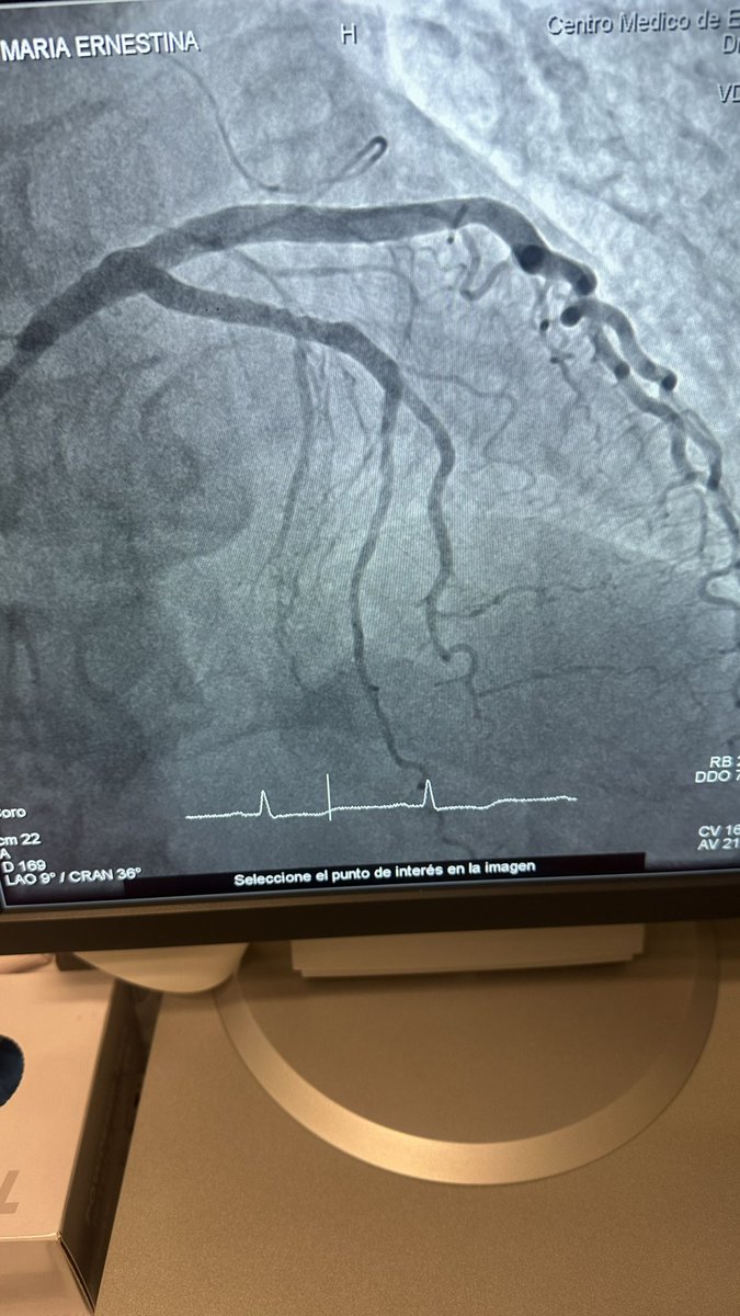 SulyBernabe's tweet photo. El antes y el después #hemodinamia #cardionuse https://t.co/t9vJeEzMXu