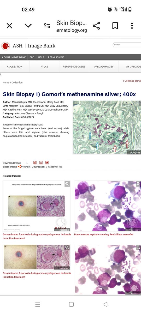 manasi_gupta's tweet photo. Grateful to everyone especially our pathology team who helped us in the diagnosis of this case ✨ https://t.co/Z3jOAcCLuA