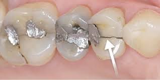 DrAliRobaian's tweet photo. السبب هنا كسر طولي في السن والجذر بسبب حشوات الزئبق المعدنية ( Amalgam)

طيب والحل؟

١- المتابعة الدورية والأشعة تقلل من مثل هذي الأضرا��
٢- لاينصح بتغيير الحشوات المعدنية الا اذا فيه سبب منطقي لتغييرها 
٣- اذا راح تتغير لازم تكون ازالتها تحت العازل المطاطي لتقليل ضرر الزئبق عند إزالتها

https://t.co/O30MNhiTXN