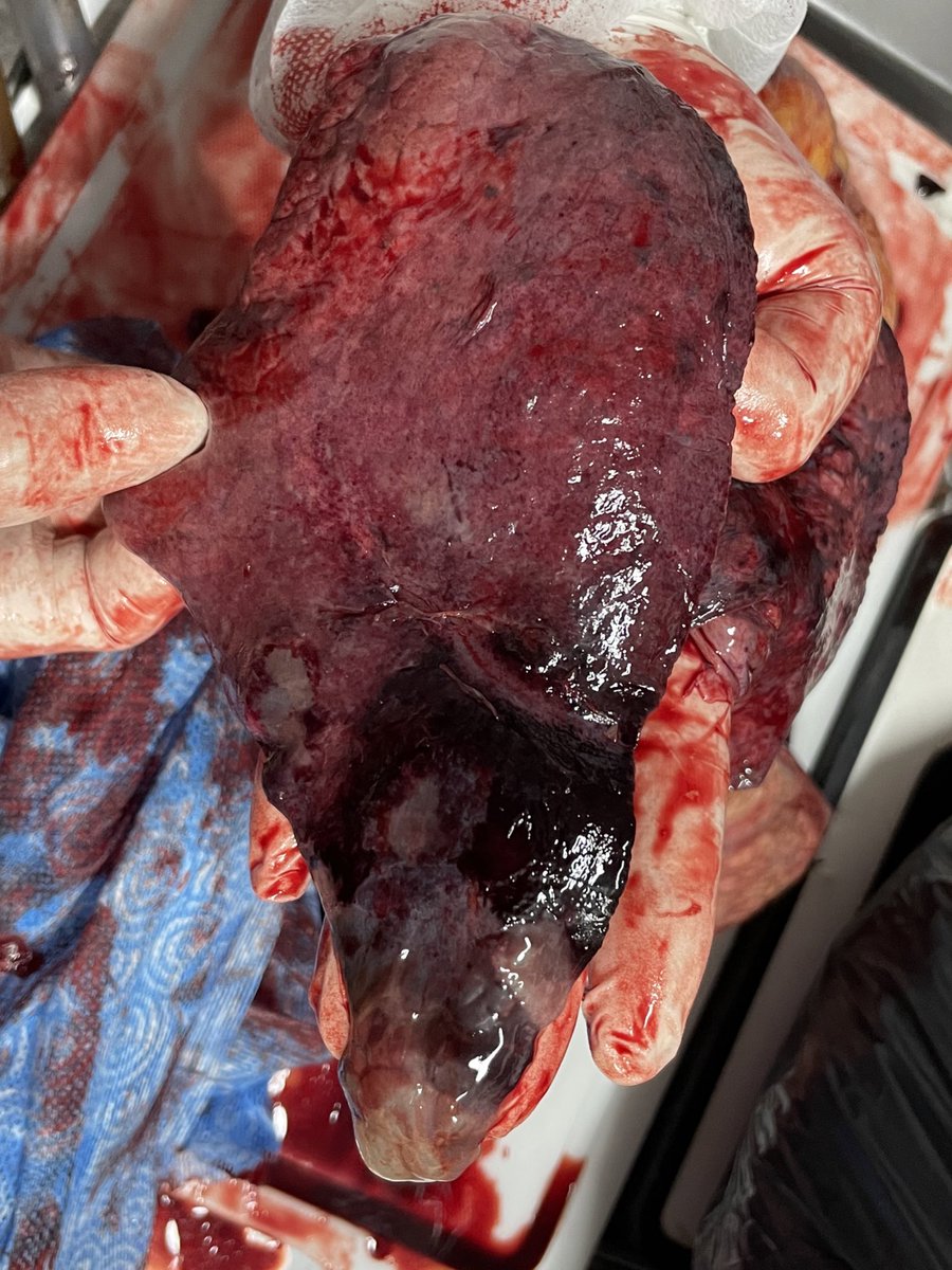 rqbittenc's tweet photo. Classic location, classic appearance. Organ: lung. What’s the finding? #autopsypath #autopsy #pathresidents #lungpath #pulmpath #pathology https://t.co/jQIhbZnvdb