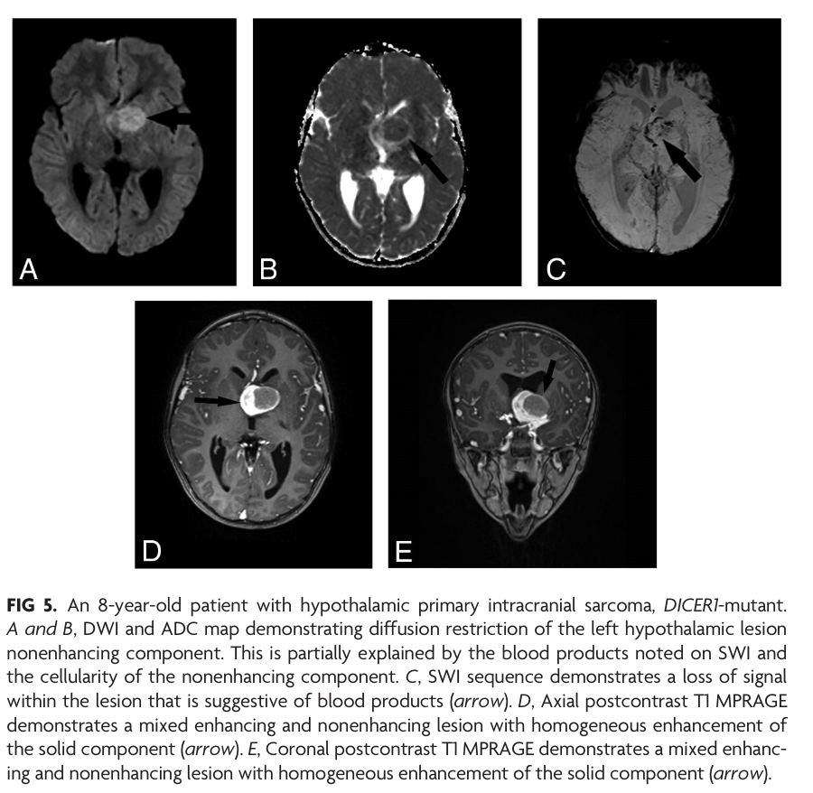 'Imaging Features of Primary Intracranial Sarcoma with DICER1 Mutation: A Multicenter Case Series' doi.org/10.3174/ajnr.A… #FellowsJournalClub