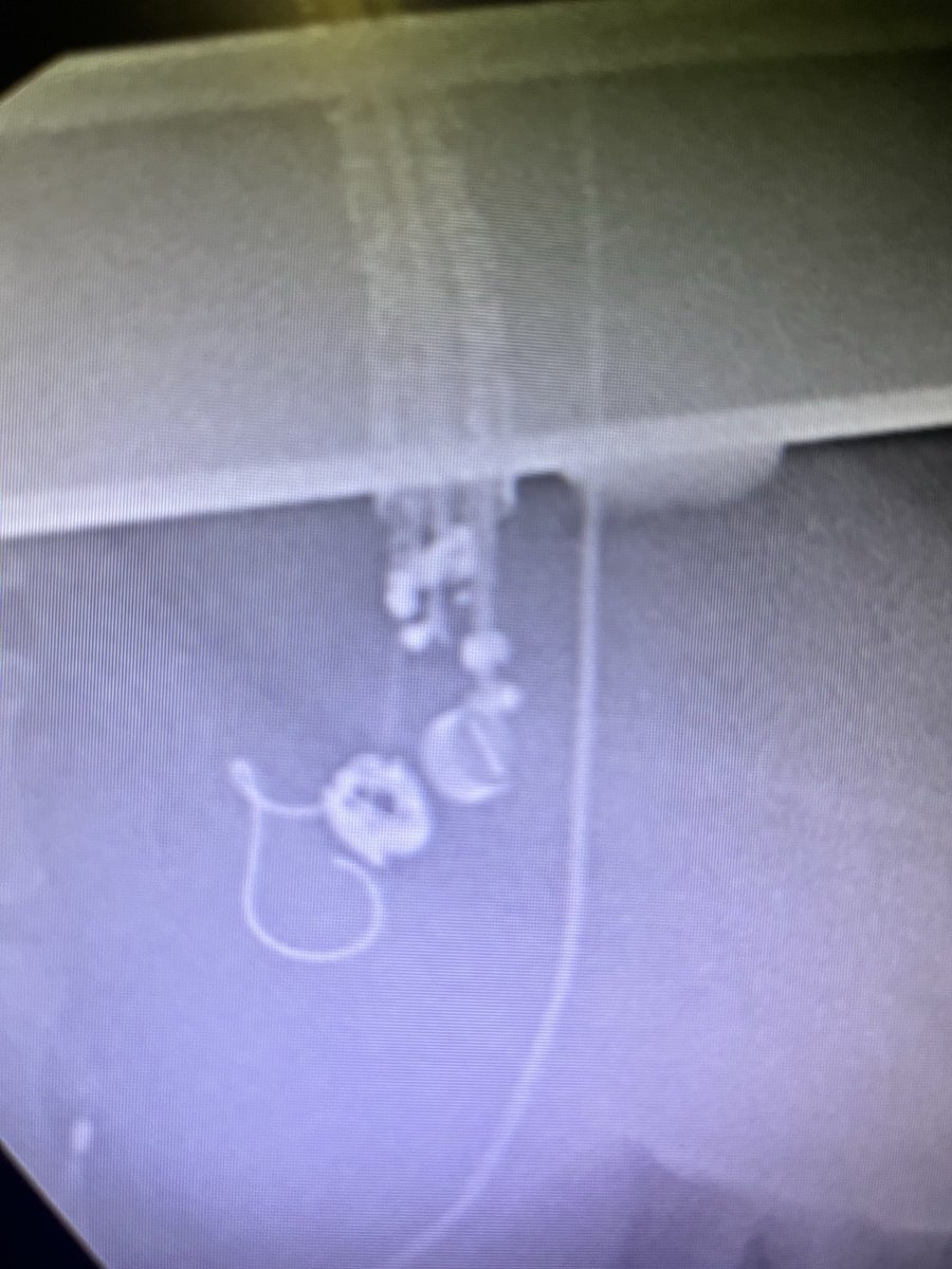 Saqib Walayat (@saqibwalayat) on Twitter photo EUS guided variceal coiling for bleeding gastric varices, thanks to <a href="/AhmadBazarbashi/">Ahmad N. Bazarbashi أحمد بازارباشي</a> for sharing his technique #GITwitter, <a href="/muhammadbaigmd/">Muhammad Arslan Baig</a> <a href="/SonuD7441/">Sonu Dhillon</a> <a href="/DeepakGIQuality/">Deepak Gopal</a> EUS guided variceal coiling for bleeding gastric varices, thanks to <a href="/AhmadBazarbashi/">Ahmad N. Bazarbashi أحمد بازارباشي</a> for sharing his technique #GITwitter, <a href="/muhammadbaigmd/">Muhammad Arslan Baig</a> <a href="/SonuD7441/">Sonu Dhillon</a> <a href="/DeepakGIQuality/">Deepak Gopal</a>