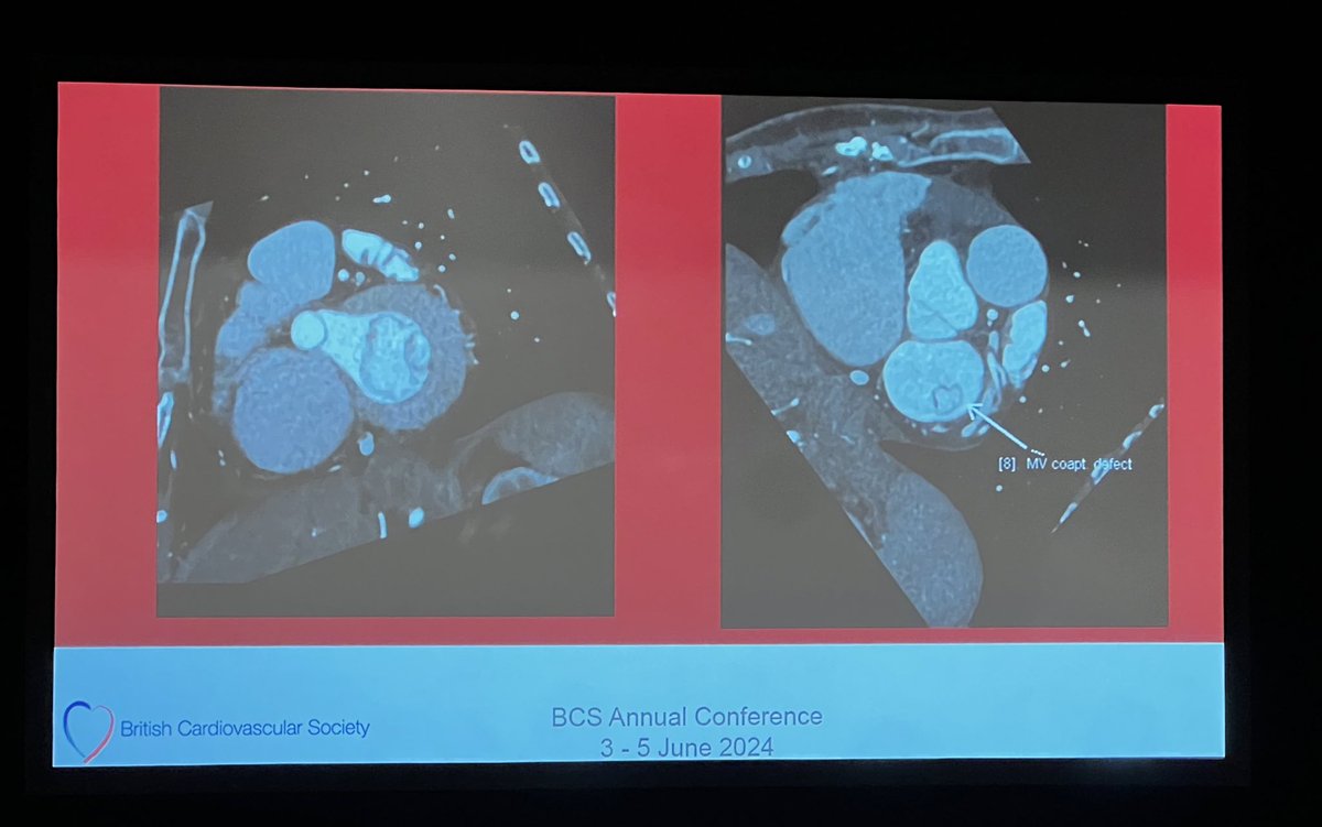 KhanKheil88's tweet photo. Live Imaging MDT #day2 #BCS2024
Beautiful cases including this case of severe MR in an elderly, frail patient with CT assessment prior to TEER, demonstrating severe MV prolapse and cortriatrium.
@erica_tirr #whyCT @sado_dan @DanXAugustine @guyll @Reidmeanna https://t.co/aezMGqt9Nv
