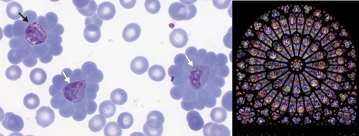 infeccHRUmalaga's tweet photo. En @NEJM MALARIA🩸🦟 #Pvivax y RECIDIVA🔄a los 3 meses #giemsa con gametocitos+trofozoitos en #ROSETON 📸👇🏻típico #Pvivax y #Pfalciparum para escapar secuestro esplenico, fagocitosis y antimalaricos, al lado ROSETÓN #NOTREDAME q abrirá sus puertas 8.12.24👏🏻tras incendio⛪️🔥
🔗🧵 https://t.co/wYLOvQYRRa
