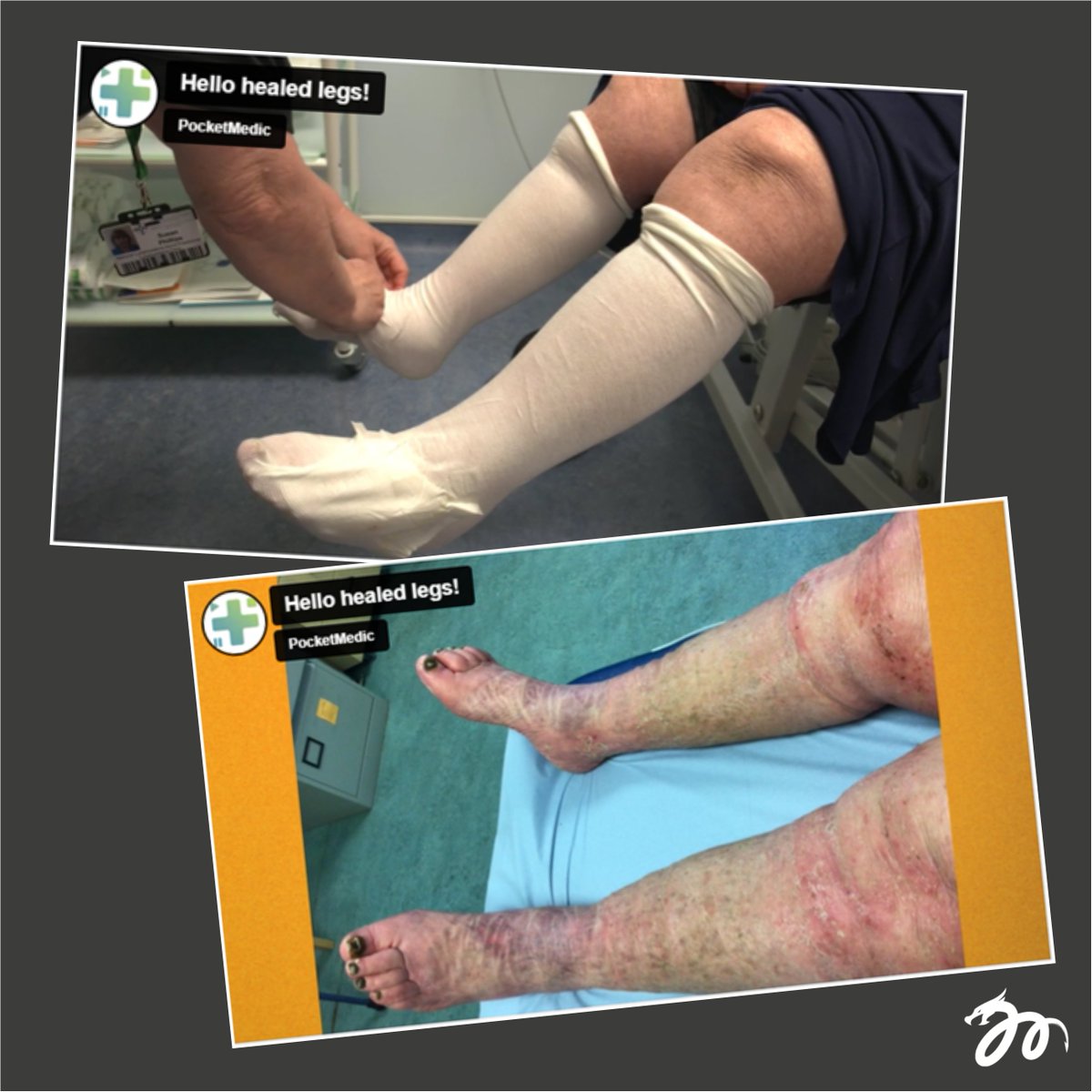 Lymphoedema Wales Clinical Network (LWCN) (@lymphnetwales) on Twitter photo Legs Matter Week - Day 1: A self-help guide for patients, to move forwards after treatment for wounds and chronic oedema.
Click to watch our video: youtu.be/vcLMfUulqBM
#lymphoedema #resources #films #lymphoedemawales #hellohealedlegs #legsmatter #legsmatterweek Legs Matter Week - Day 1: A self-help guide for patients, to move forwards after treatment for wounds and chronic oedema.
Click to watch our video: youtu.be/vcLMfUulqBM
#lymphoedema #resources #films #lymphoedemawales #hellohealedlegs #legsmatter #legsmatterweek