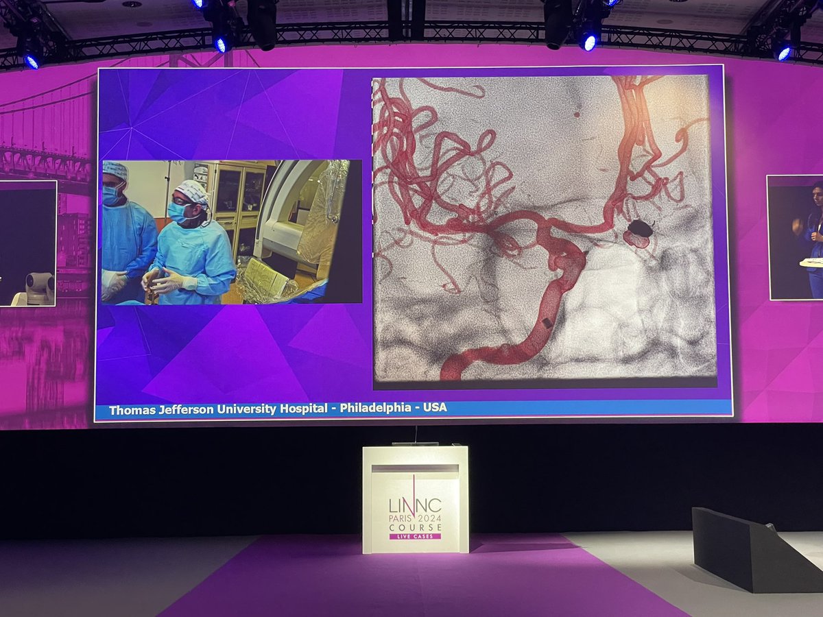 C. J. Jared Chen, MD, FAANS (@chenjared) on Twitter photo Great to see <a href="/PascalJabbourMD/">Pascal Jabbour MD, FAANS, FACS, FAHA</a> (doing femoral!!) from <a href="/TJUHNeurosurg/">Jefferson Neurosurgery</a> live transmitting a @MV_Terumo FRED X #aneurysm case to <a href="/LINNConline/">LINNC online 🧠</a> #LINNCParis 2024! <a href="/StavTjoumakaris/">Stavropoula Tjoumakaris MD, MBA, FAANS, FACS, FAHA</a> <a href="/vitorpereiracan/">Vitor Mendes Pereira</a> <a href="/rhrosenwasser/">ROBERT H ROSENWASSER</a> #neuroradiology #inr Great to see <a href="/PascalJabbourMD/">Pascal Jabbour MD, FAANS, FACS, FAHA</a> (doing femoral!!) from <a href="/TJUHNeurosurg/">Jefferson Neurosurgery</a> live transmitting a @MV_Terumo FRED X #aneurysm case to <a href="/LINNConline/">LINNC online 🧠</a> #LINNCParis 2024! <a href="/StavTjoumakaris/">Stavropoula Tjoumakaris MD, MBA, FAANS, FACS, FAHA</a> <a href="/vitorpereiracan/">Vitor Mendes Pereira</a> <a href="/rhrosenwasser/">ROBERT H ROSENWASSER</a> #neuroradiology #inr