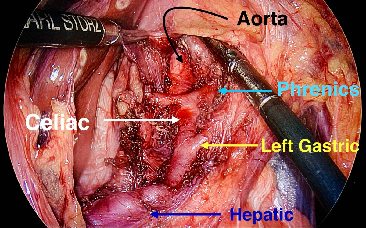 OMGhanemMD's tweet photo. View of Median Arcuate Ligament Release with phrenics crossing anteriorly exactly where the ligament was 

#MALS #SurgEd #Anatomy #MedStudentEd #Anatomy https://t.co/DgOUaRA91f