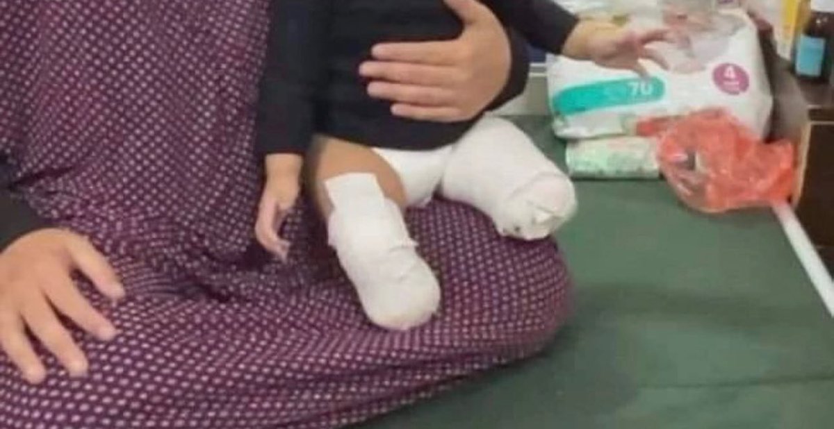 Gaza tem agora o maior número de crianças amputadas da HISTÓRIA.

Israel fez isso. 👇🏽