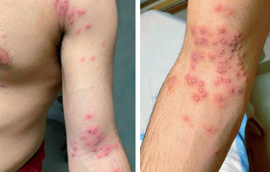 NEJM CPC (@nejmcpc) on Twitter photo Case 16-2024 discussion of multifocal pustular #rash <a href="/dr_demetre/">DrDemetre</a>
Differential diagnosis
▶️non-infectious (autoimm, derm, cancer, drug)
▶️ viral HSV, VZV, MPXV > parvo, entero, HIV
▶️ 🦠Staph, PsA, syphilis
▶️ 🍄
nejm.org/doi/full/10.10…
<a href="/ericashenoy/">Erica S. Shenoy, MD, PhD</a> <a href="/HowardHeller/">HowardHeller</a> #KathyHsu Case 16-2024 discussion of multifocal pustular #rash <a href="/dr_demetre/">DrDemetre</a>
Differential diagnosis
▶️non-infectious (autoimm, derm, cancer, drug)
▶️ viral HSV, VZV, MPXV > parvo, entero, HIV
▶️ 🦠Staph, PsA, syphilis
▶️ 🍄
nejm.org/doi/full/10.10…
<a href="/ericashenoy/">Erica S. Shenoy, MD, PhD</a> <a href="/HowardHeller/">HowardHeller</a> #KathyHsu