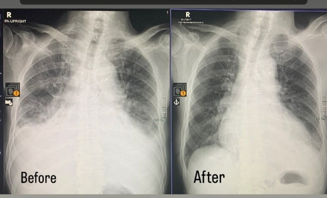 First solo ultrasound-guided thoracentesis as a first year proto-Radiologist 🥳

I then did two more today. It's amazing because this procedure results in immediate and drastic relief for patients. It's also quite satisfying to aspirate fluid.