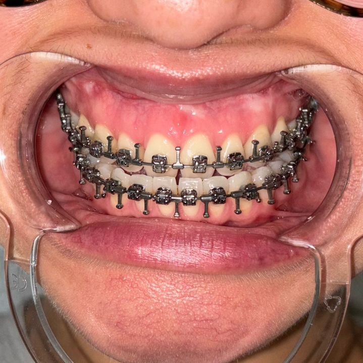 CassandraPatati's tweet photo. Surgical hooks: on 💪
Surgery mode: activated 😎
#JawSurgery #DJS #Underbite https://t.co/HUbuG5YoLq