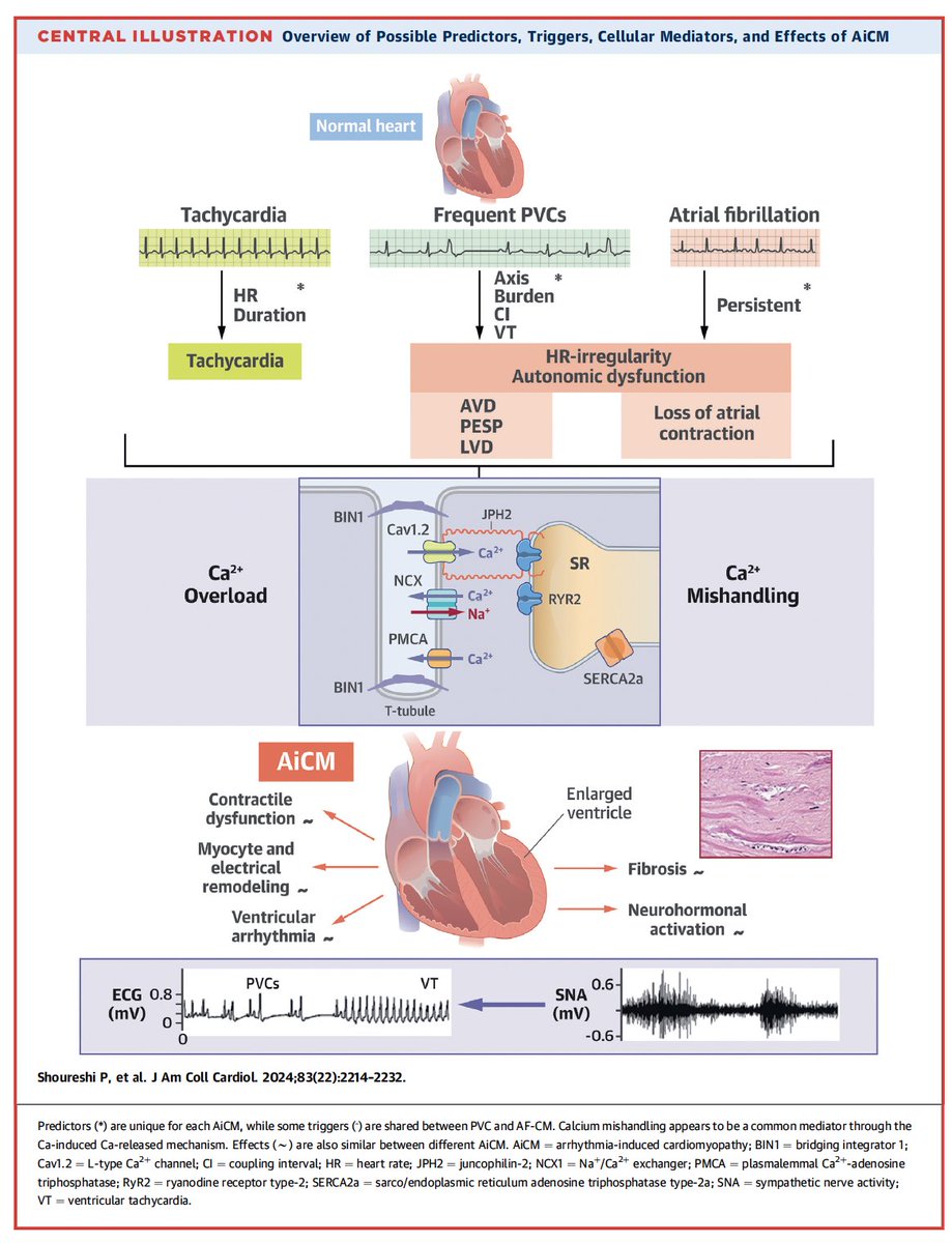 LAHRSonline1's tweet image. Cardiomiopatía inducida por arritmias ⚡️

-Taquicardia, FA y extrasístoles ventriculares→AiCM
-Importante comprender su fisiopatología
-#ECGfirst y #WhyCMR →claves para el Dx
-Causas reversibles e irreversibles
-Score riesgo ABC-VT para AiCM

jacc.org/doi/10.1016/j.…