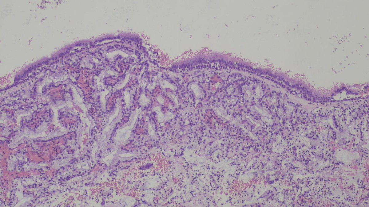 BSepodes's tweet photo. Cell-block from a bronchial washing of an 80-year-old male. 
IMH: CD56, TTF1, p40, SOX10, and S100 are all negative. 
Any clues? 
#pathtwitter #cytopath #pulmpath https://t.co/xrVpaHWjjf
