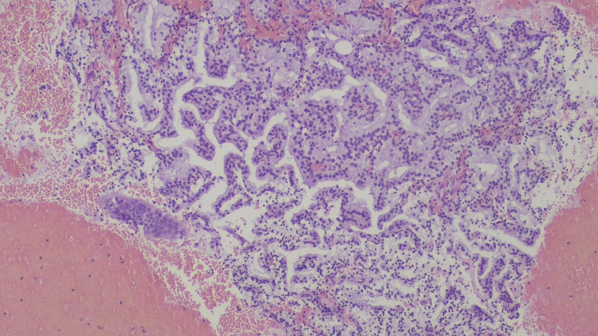 BSepodes's tweet photo. Cell-block from a bronchial washing of an 80-year-old male. 
IMH: CD56, TTF1, p40, SOX10, and S100 are all negative. 
Any clues? 
#pathtwitter #cytopath #pulmpath https://t.co/xrVpaHWjjf