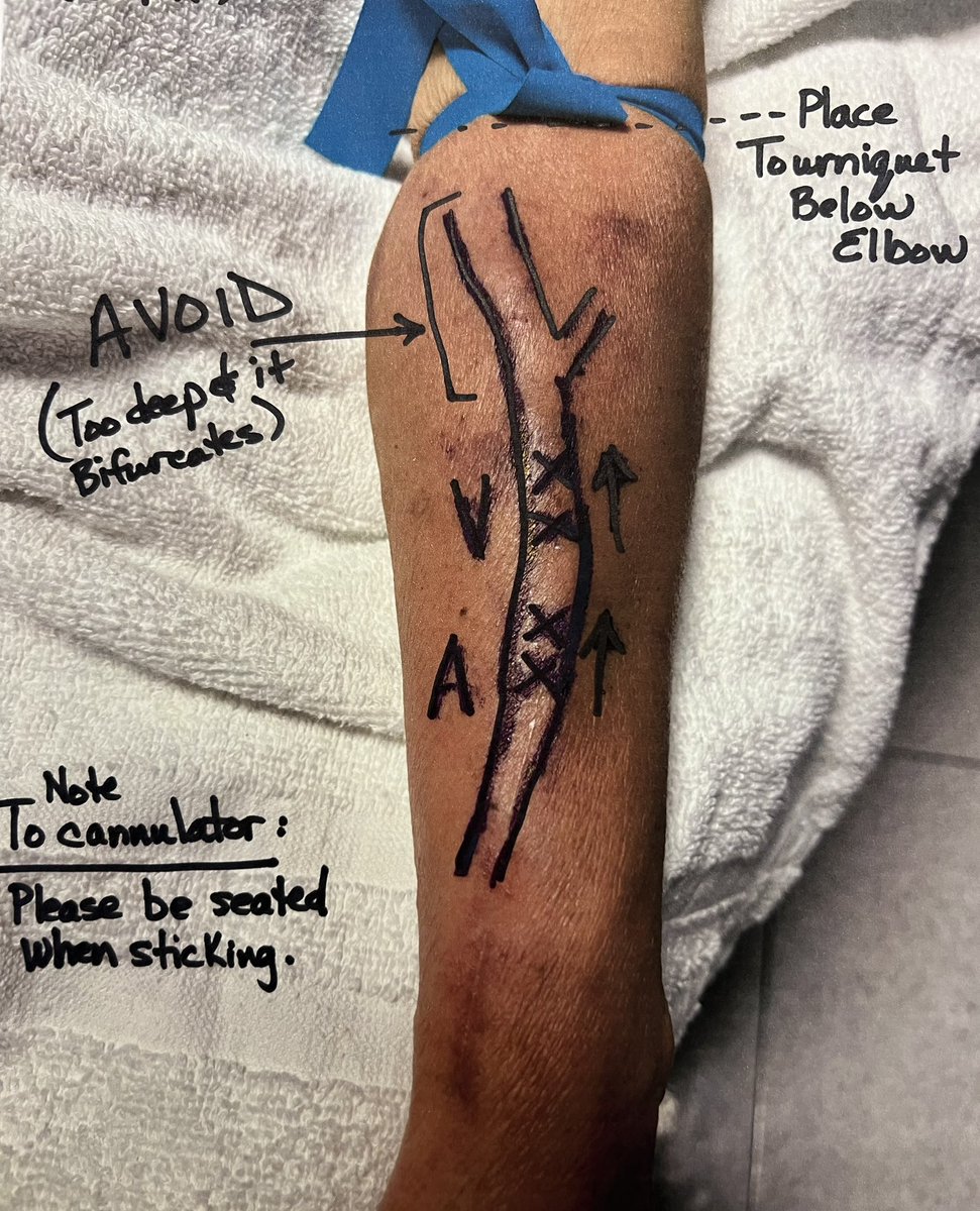 Cannulation can be hard. 😓
Doing our part to make it easier.