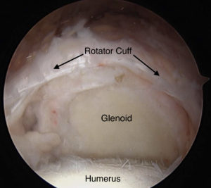 DrJeffBerg's tweet photo. Some rotator cuff tears are irreparable. These tears can cause significant pain and disability. Learn more about them here... #RotatorCuffTears
https://t.co/WJoEKmIHjD https://t.co/uxeii0dOzG