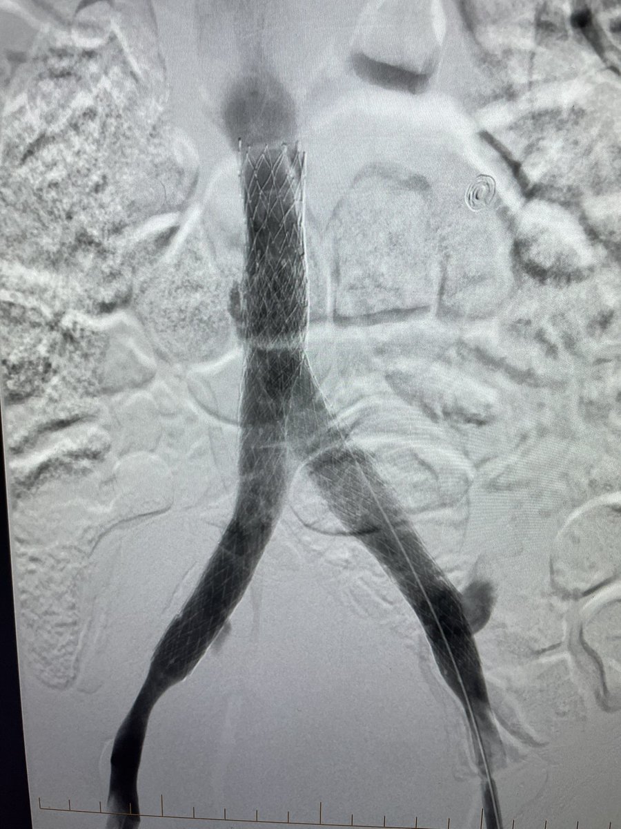 Recanalization of chronically occluded IVC and iliac veins.  I bang my head on the wall for these cases but when you have a success it feels great.  <a href="/InariMedical/">Inari, now part of Stryker</a> <a href="/MDTVascular/">Medtronic Vascular Health</a> <a href="/Thomas_TuMD/">Thomas Tu MD</a>