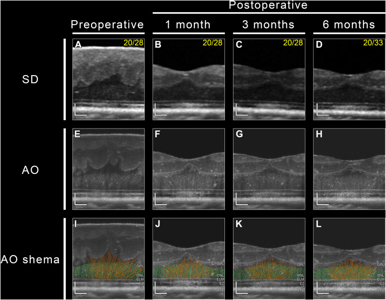 Cellular Determinants of Visual Outcomes in Eyes with Epiretinal Membrane: Insights from Adaptive Optics Optical Coherence Tomography
ow.ly/XAb950RnZcw