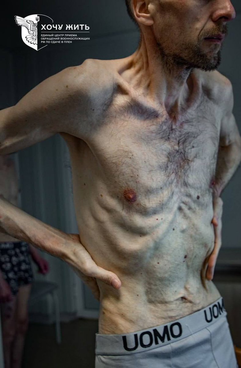 IAPonomarenko's tweet photo. The year is 2024.

And this is what happens in Europe in our time. 

Roman Horilyk, a Ukrainian serviceman with the National Guards, was taken prisoner at the Chornobyl Nuclear Power Plant, and he has spent over two years in Russian captivity.

This is his condition as he gets back home to Ukraine following the latest prisoner swap.

History repeats itself and cries for its lessons to be learned.