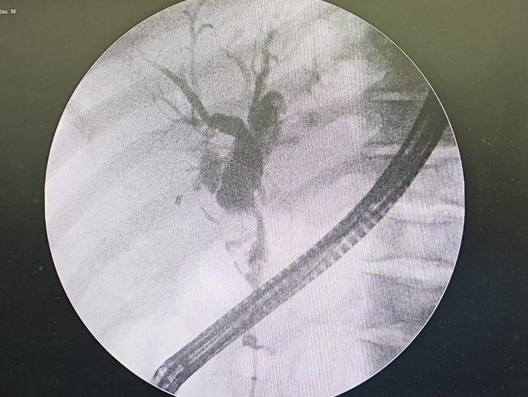 Taalamri's tweet image. 🔴Sphincteroplasty upto 15mm is good strategy to achieve full ductal clearance.This case referred for spyglass;CRE Dilatation 12mm successfully made the duct cleaned.
@Almotasembilla1
@AlmuhaidbAymen
@CarlKayMD
@SyedGerdezi
@DrSalihTokmak
@drkeithsiau
#ERC
#Teaching
#Cholangitis
