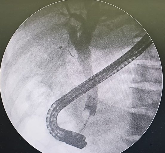 Taalamri's tweet image. 🔴Sphincteroplasty upto 15mm is good strategy to achieve full ductal clearance.This case referred for spyglass;CRE Dilatation 12mm successfully made the duct cleaned.
@Almotasembilla1
@AlmuhaidbAymen
@CarlKayMD
@SyedGerdezi
@DrSalihTokmak
@drkeithsiau
#ERC
#Teaching
#Cholangitis