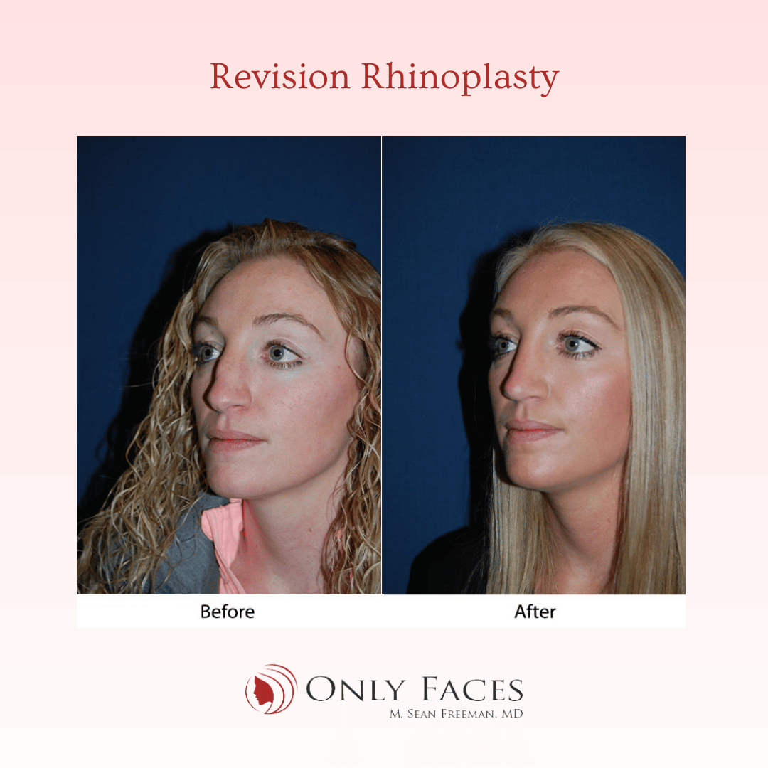 OnlyFacesCLT's tweet photo. This 31-year-old is two weeks post-op from a Revision #Rhinoplasty with Dr. Sean Freeman. #OnlyFaces https://t.co/2V2eudlOqR