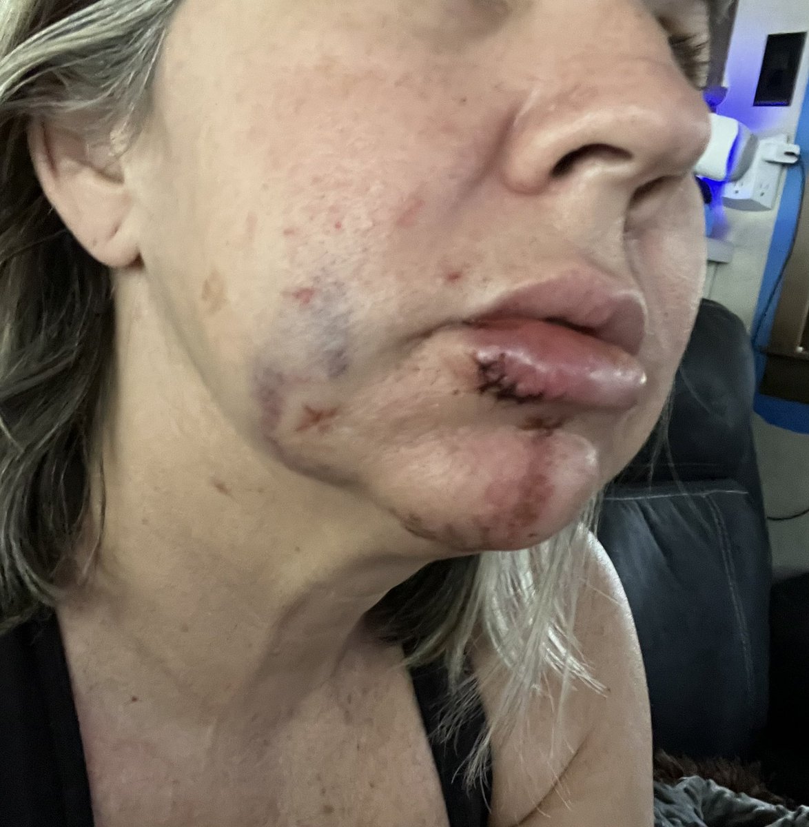 jenloveslon's tweet image. You know what I want you to know??? Long Covid is real. Dysautonomia is real. Autoimmune after Long Covid is real and immunocompromised is real. Passing out because your blood pressure sucks is real. #SSDI #longcovid #dysautonomia #syncope