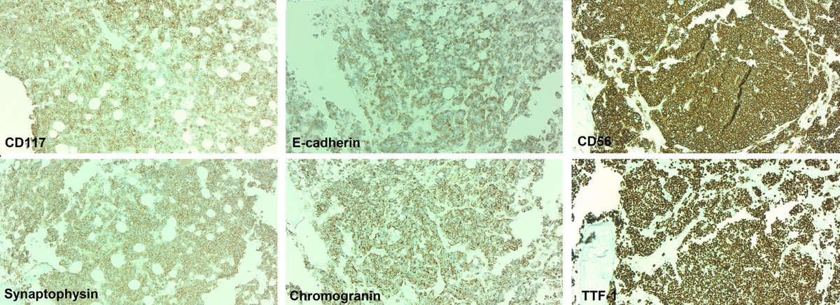 70s, pancytopenia, no hx/imaging.
Dx: Met ca with NE diff, favor lung.

Almost came very close to call it erythroid hyperplasia and move on. The clusters on aspirates bothered me to do more IHCs. F/u showed lung small cell ca!

FISH: del(5q)! More info⬇️
#PathTwitter #HemePath