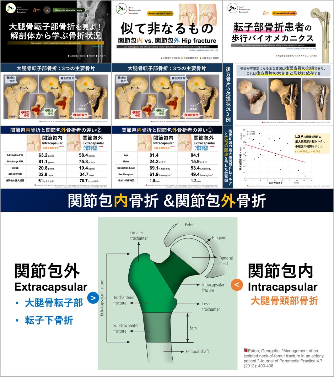γ-nailの術侵襲💡 中殿筋, 外側広筋, TFL, ITB！ 関連する文献抄読を